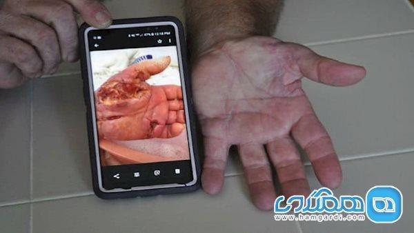 بیماری ای که ذره ذره گوشت شما را می خورد! بیماری ای که ذره ذره گوشت شما را می خورد!